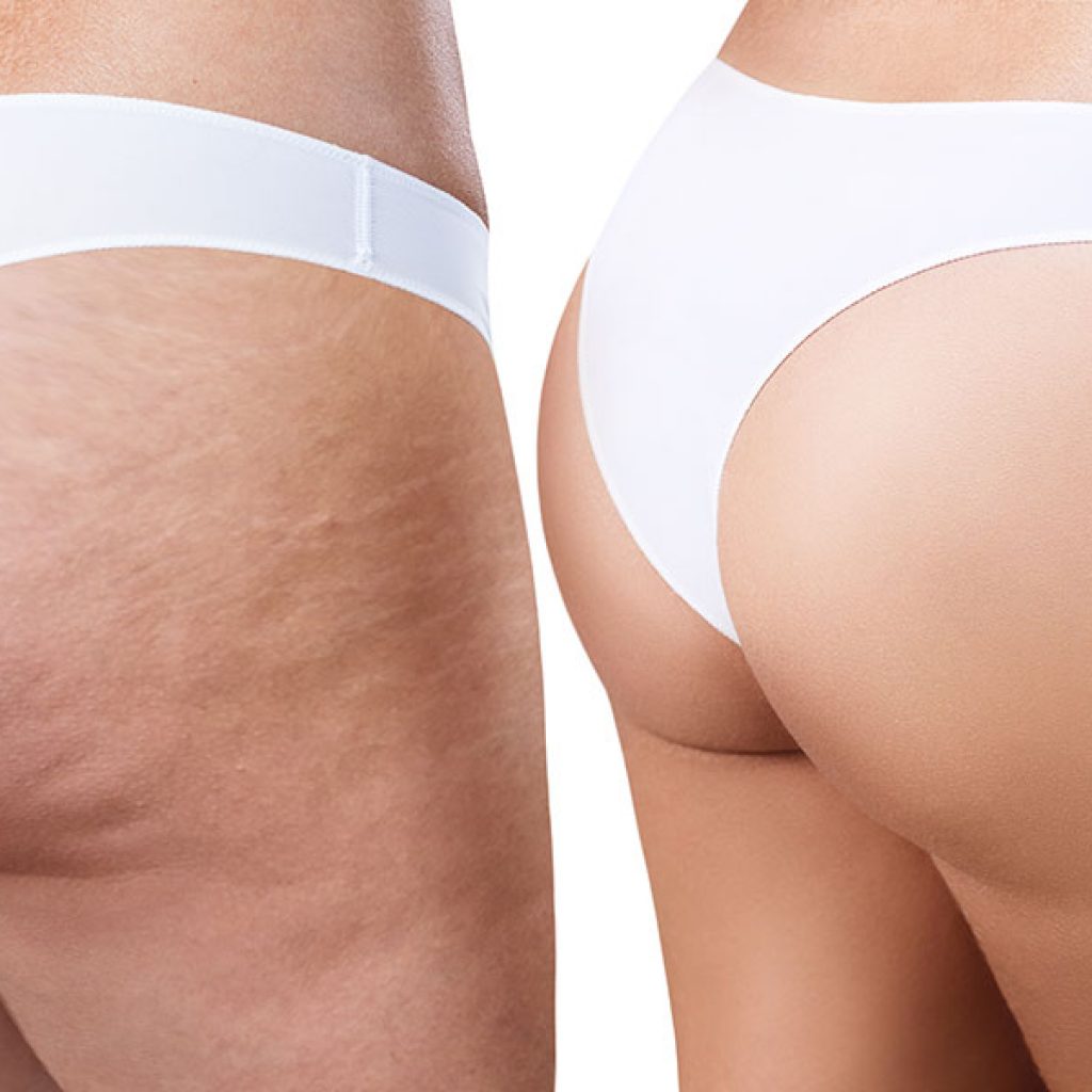 pure-c-unterberger-cellulite